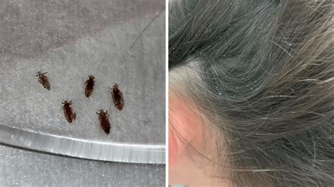 Overcoming the Social Stigma of Lice: Education and Awareness