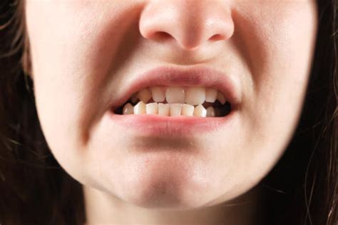 Personal Associations: Exploring Your Individual Connection with Misaligned Teeth