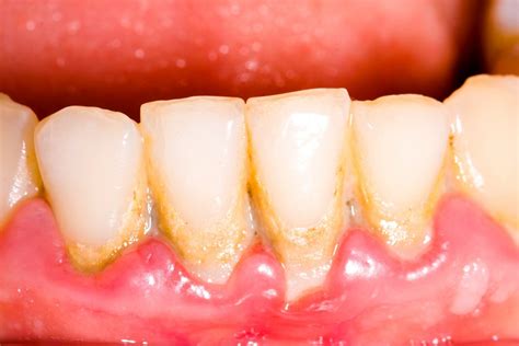 Poor Oral Hygiene and Its Impact on Gum Recession