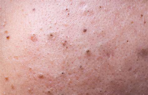 Poppable or Not? Different Types of Blackheads