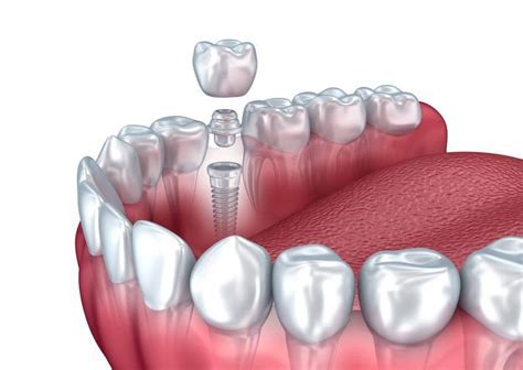 Possible Causes and Triggers for Vivid Dreams Involving Dental Hemorrhage