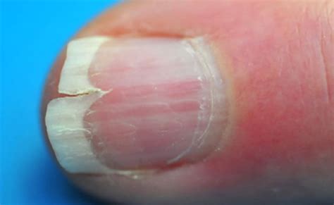 Possible Health Conditions Associated with Splitting Nails