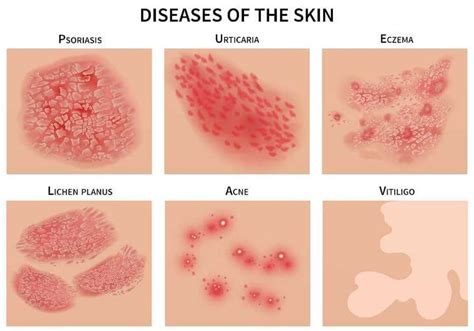 Possible Interpretations of Dreams Involving Individuals Affected by Dermatological Conditions