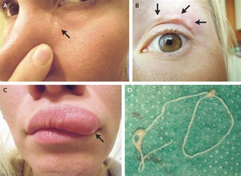 Possible Meanings and Interpretations of Worms Moving on the Facial Region