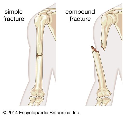 Possible Meanings of Dreaming of a Person Sustaining a Fracture or a Breakage in Their Skeletal Structure