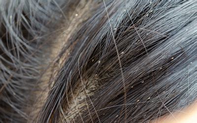 Practical Tips for Coping with Lice-Related Dreams