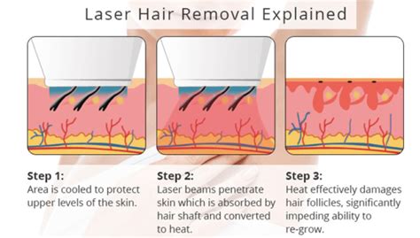 Preparing Your Skin for Effective Hair Removal