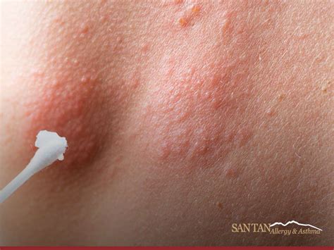 Preventing Recurring Skin Hives: Essential Tips for Long-Term Relief