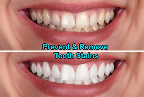 Preventing Teeth Stains: Tips and Tricks