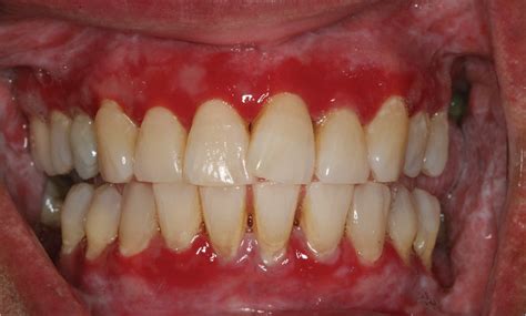 Preventing and Managing Recurring Oral Lesions