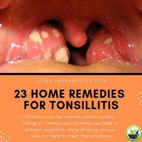 Prevention is Key: Tips for Avoiding Tonsil Swelling