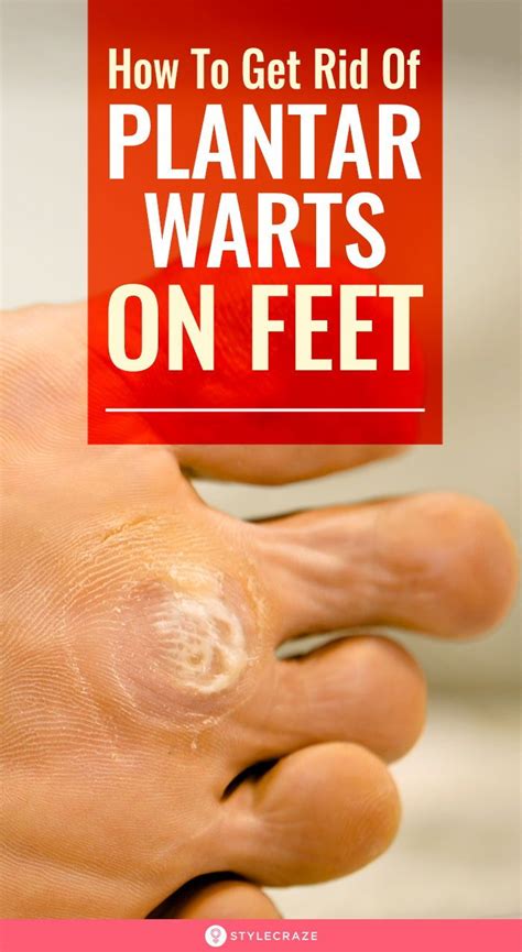 Preventive Measures to Avoid Toes Wart