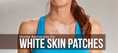 Preventive Measures to Avoid the Formation of Pale Patches on Your Skin