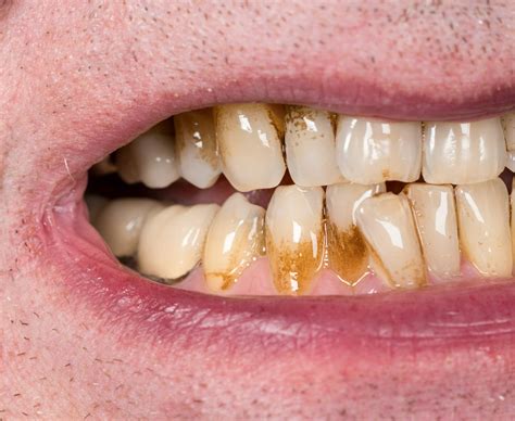 Professional Techniques to Address Resilient Tooth Stains