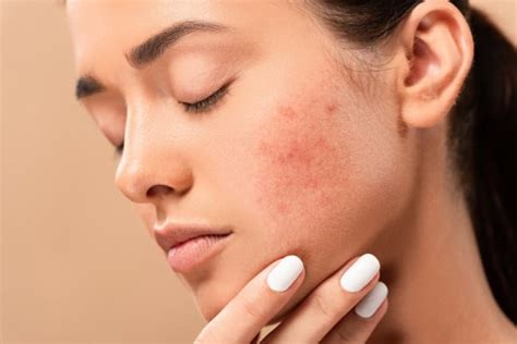 Proven Techniques for Fighting Acne