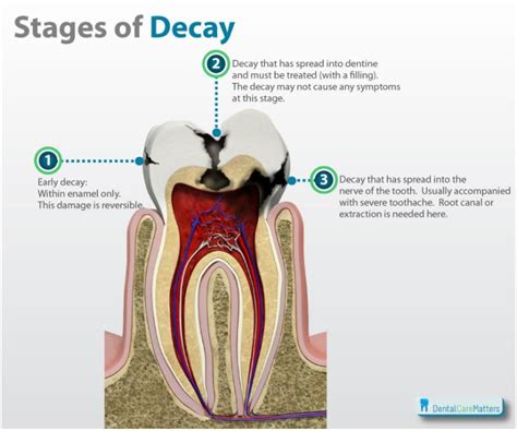 Psychological Insights: Revealing the Significance of Decay and Damage in Dental Dreams