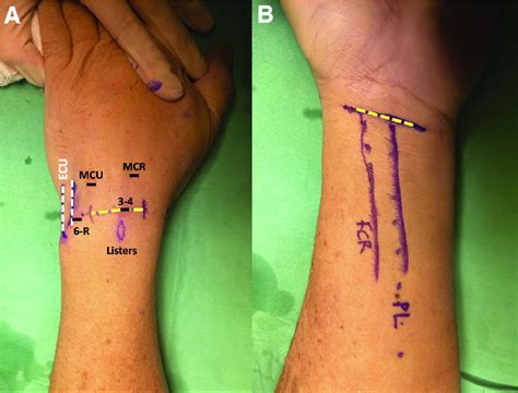 Psychological Perspectives: Exploring the Potential Significance of Wrist Incisions