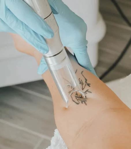 Reasons for Tattoo Removal: Unveiling the Motivations Behind Erasing Ink