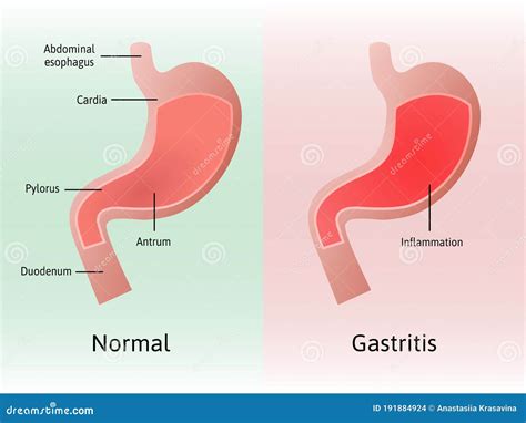 Recognizing Potential Disorders or Allergies Indicated in Dreams about Stomach Irritation