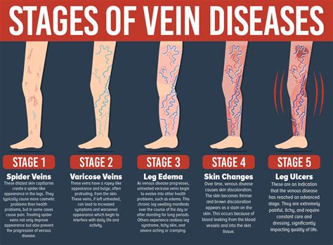 Recognizing Symptoms of Leg Veins: Should You Be Concerned?