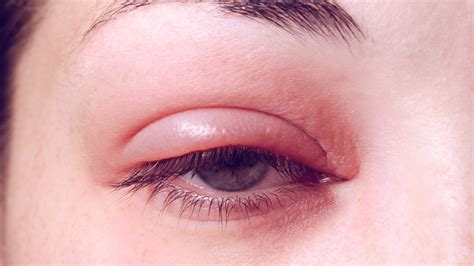 Recognizing the Signs of an Eye Infection