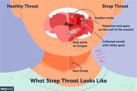 Recognizing the Signs of an Inflamed Throat