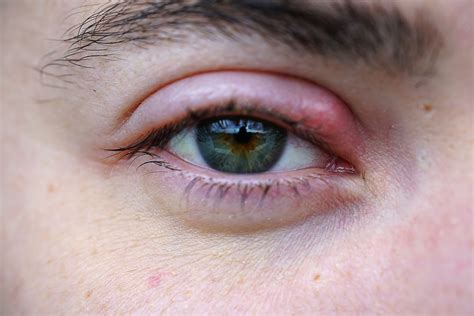 Recognizing the Symptoms and Early Signs of an Eye Stye