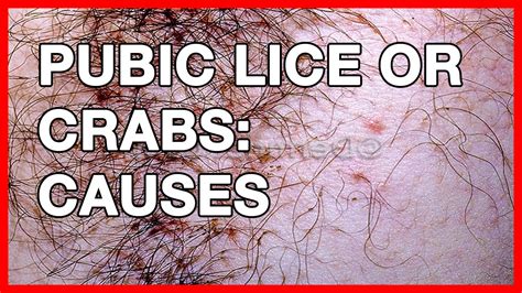 Recognizing the Symptoms of Pubic Lice Infection