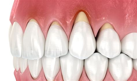 Recognizing the Symptoms of Receding Gums: What to Look For