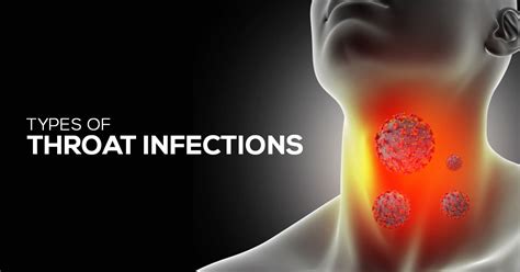 Respiratory Infections: The Culprit Behind Throat Inflammation