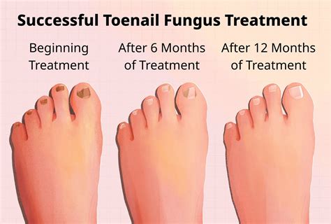 Risk Factors to Watch Out For: Who Is Prone to Toenail Fungus