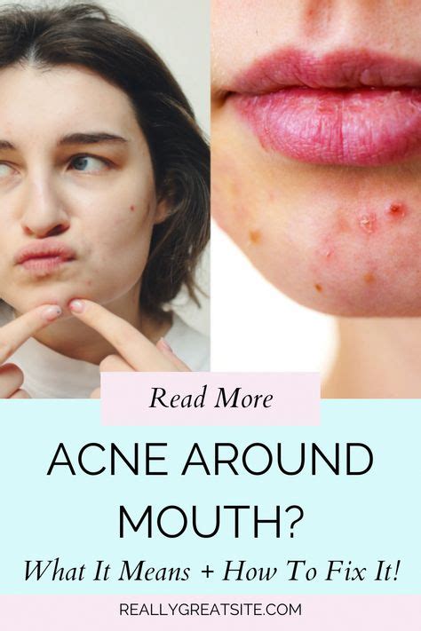 Say Goodbye to Blemishes: Effective Strategies to Combat Acne