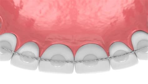 Seeking Perfection: Understanding Orthodontic Retainers