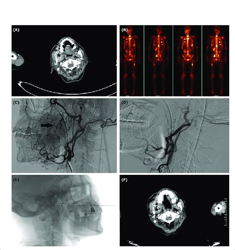 Seeking Professional Assistance for Recurrent Oral Hemorrhage Reveries