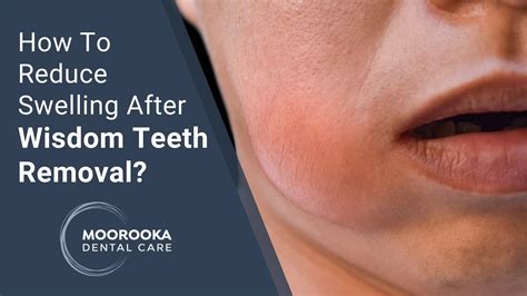 Seeking Professional Help: When and Why Should You Be Concerned about Dreams of Wisdom Teeth Extraction?