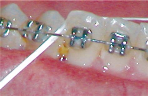 Seeking Relief: Effective Solutions for Threads Caught Between Teeth