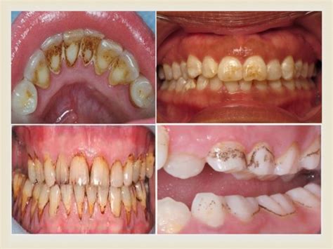 Significance of Teeth Discoloration: Decay and Neglect