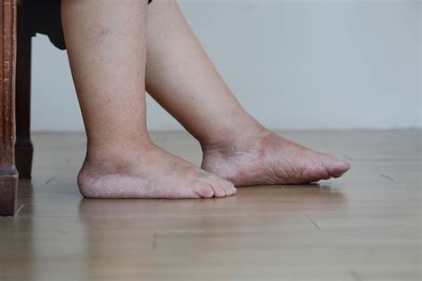 Signs that Indicate the Need for Medical Attention Regarding Leg Swelling