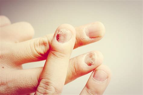 Sneaky Culprits: Common Causes of Nail Fungus Infections