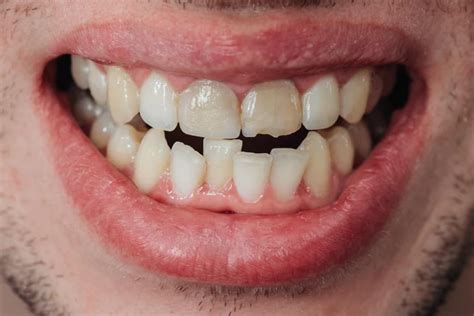 Steps to Tackling the Concerns Unveiled in Dreams About Discolored Teeth