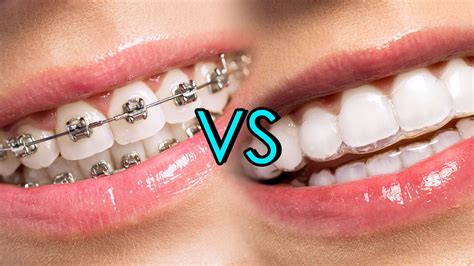 Straightening Teeth: Braces vs. Invisalign