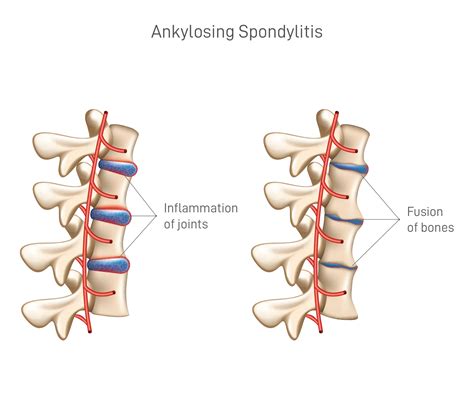 Struggles with Ankylosing Spondylitis