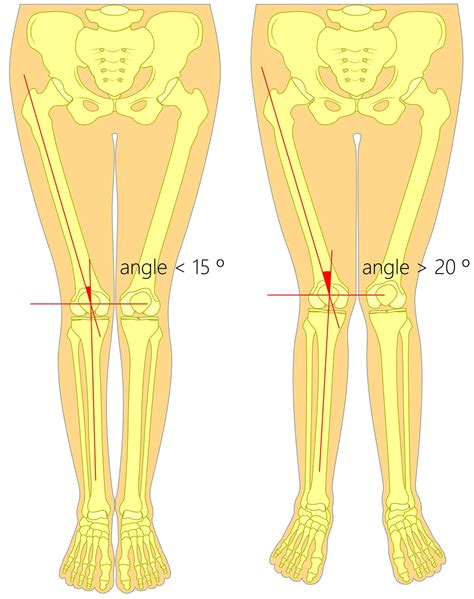 Surgical Procedures to Address Unequal Leg Length