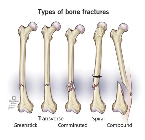 Symbolism and Interpretation of Fractured Bones