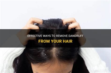 Tackling Dandruff: Effective Remedies to Eliminate those Annoying Flakes