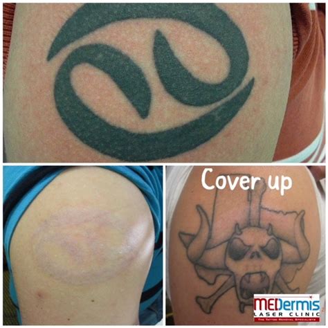 Tattoo Removal Techniques: Pros and Cons