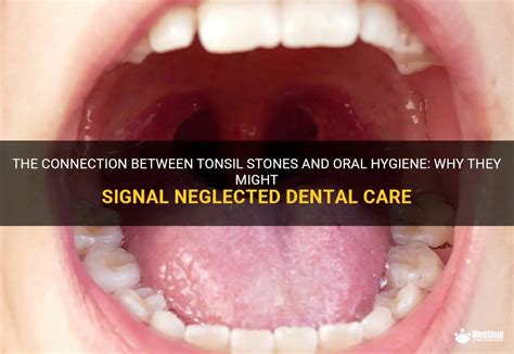 The Connection between Oral Care and Tonsil Stone Formation