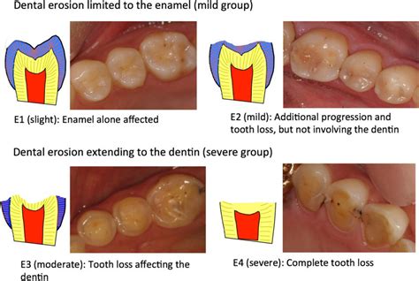 The Correlation between Dental Erosion and Emotional Distress