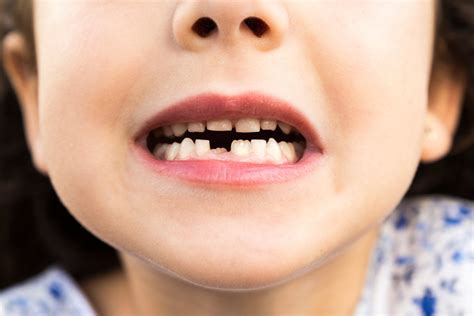 The Cryptic Significance of Losing Multiple Teeth