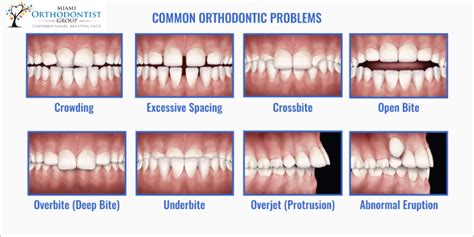 The Effects of Orthodontic Treatment: Long-Term Maintenance of Aligned Teeth